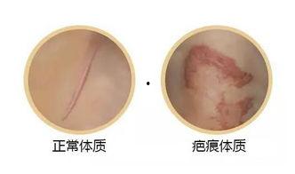 疤痕体质照片,照片背后的疤痕故事